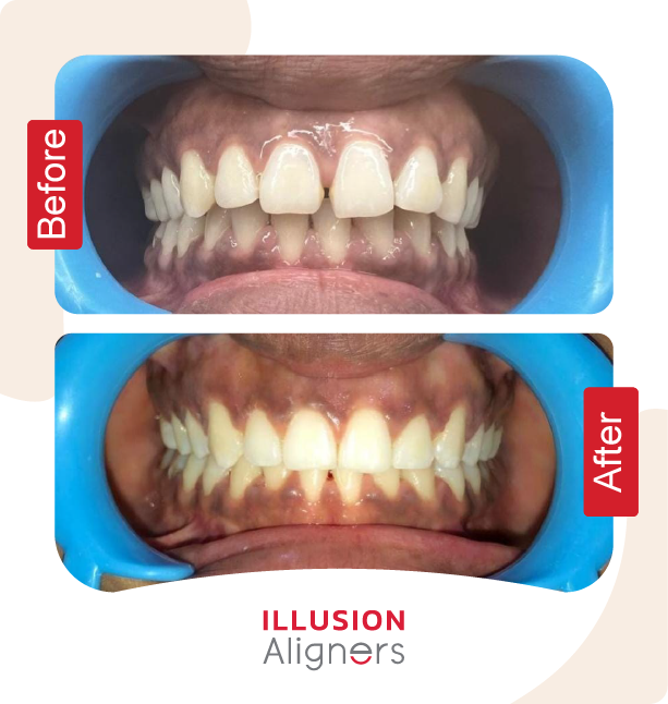 Illusion Aligners