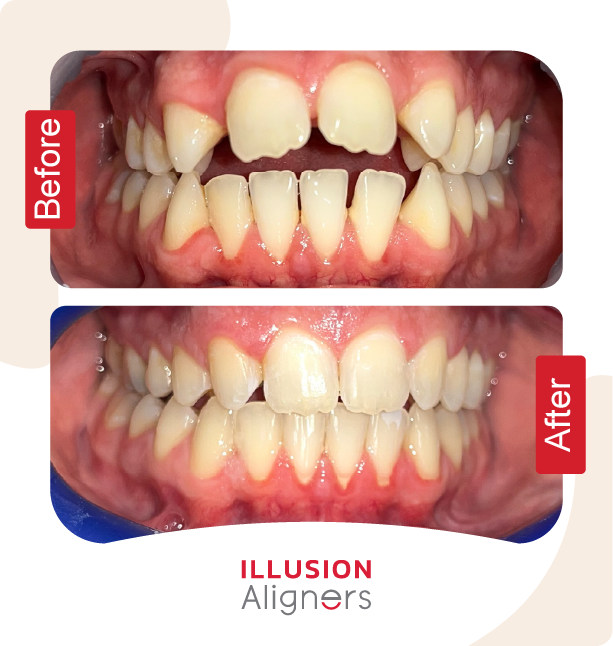 Illusion Aligners